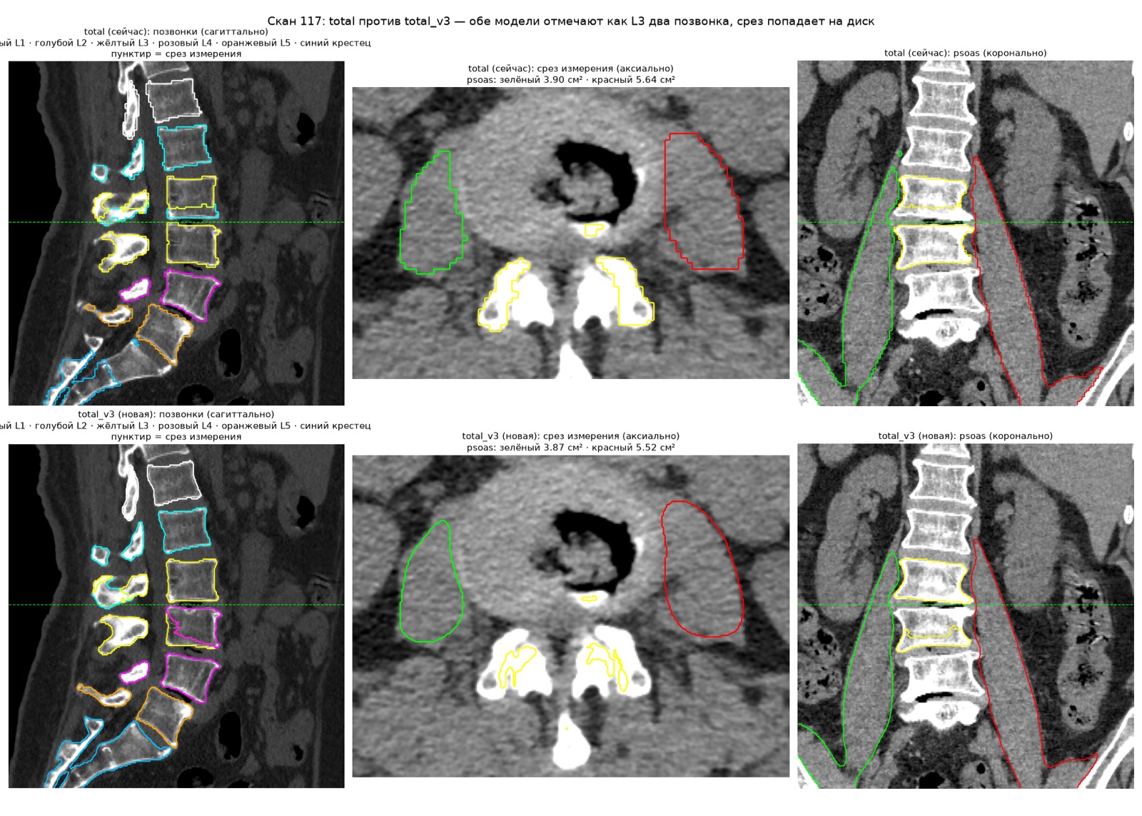 Comparison of two segmentation model versions on one CT scan